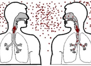 Penyakit TBC (ilustrasi).