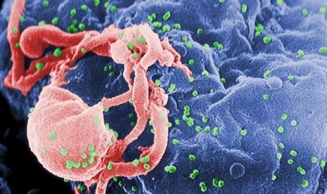 Scanning electron micrograph of HIV-1 (in green) budding from cultured lymphocyte. Multiple round bumps on cell surface represent sites of assembly and budding of virions. (illustration) 