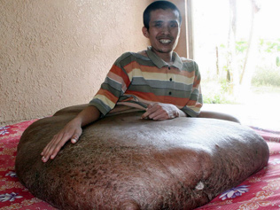 Pria Ini Mengidap Tumor Terbesar dengan Berat 80kg