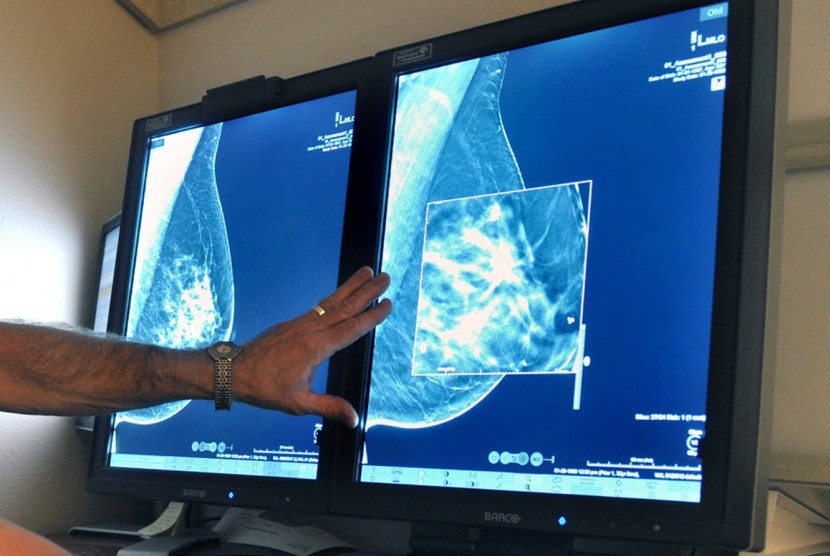 2-D teknologi mammogram ke 3-D Digital tomosynthesis Payudara mamografi Teknologi ini dapat mendeteksi kanker Payudara jauh lebih kecil sebelumnya.