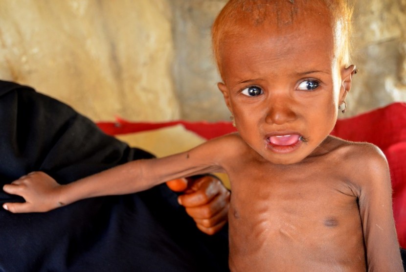 Anak-anak di Yaman menderita gizi buruk dan kelaparan karena blokade yang dilakukan koalisi Arab Saudi.