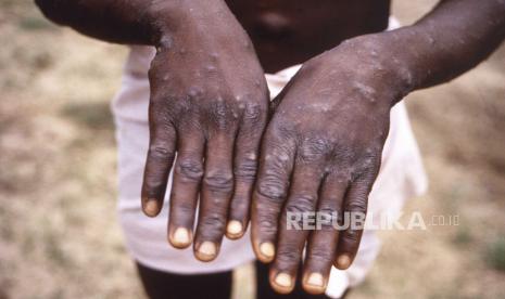 Foto dari tahun 1997 ini disediakan oleh CDC selama penyelidikan wabah cacar monyet, yang terjadi di Republik Demokratik Kongo (DRC), sebelumnya Zaire, dan menggambarkan permukaan punggung tangan pasien kasus cacar monyet, yang menunjukkan munculnya ruam khas selama tahap penyembuhannya. Cacar monyet dan cacar air adalah dua penyakit yang tidak saling berkaitan.