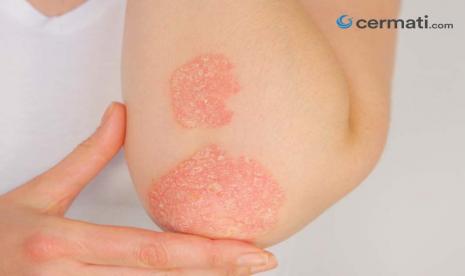 Penyakit Psoriasis: Penyebab, Gejala, serta Cara Pengobatannya