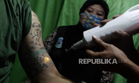 Metode hapus tato dilakukan dengan menggunakan laser yang makan waktu 30 menit. Ilustrasi.