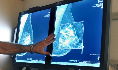 2-D teknologi mammogram ke 3-D Digital tomosynthesis Payudara mamografi Teknologi ini dapat mendeteksi kanker Payudara jauh lebih kecil sebelumnya.