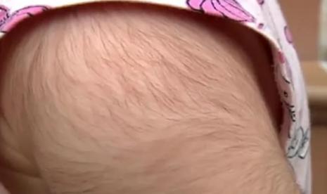 Lengan seorang anak di Spanyol ditumbuhi rambut setelah mendapatkan obat penumbuh rambut alih-alih obat sakit perut. Insiden yang menimpa setidaknya 20 anak pada 2018 ini terjadi akibat salah pelabelan obat dalam sediaan sirup.