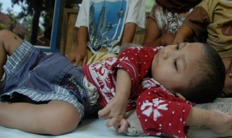 A four year toddler from Madura, East Java, suffers malnutrition as the threats of malnutrition still lingers in Indonesia. (illustration) 