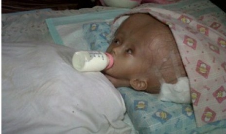 Bocah yang mengidap penyakit  hydrocephalus