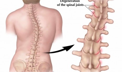 Bentuk tulang yang mengalami skoliosis.