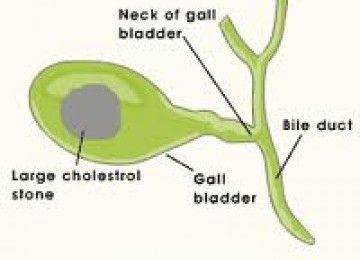 Gallbladder stone (graphic)