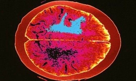 Hasil CT-Scan penderita kanker otak (ilustrasi).