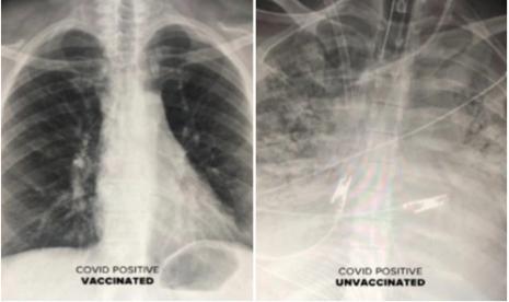 Hasil rontgen paru pasien Covid-19 yang sudah divaksinasi (kiri) vs belum divaksinasi.