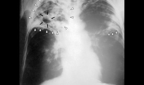 Hasil Sinar-X dada seorang penderita Tuberkulosis (TB) tingkat lanjut. Panah putih menunjukkan adanya infeksi pada kedua belah paru-paru. Panah hitam menunjukkan adanya lubang yang sudah terbentuk.