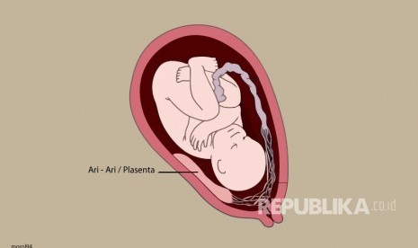 Keguguran bayi (ilustrasi). Salah satu faktor penyebab keguguran terjadi berulang (keguguran terjadi tiga kali berturut-turut atau lebih) adalah kelainan di sisi janin.