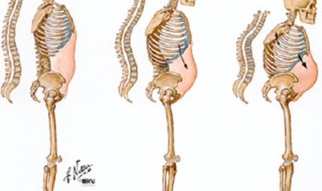 Ilustrasi osteoporosis.