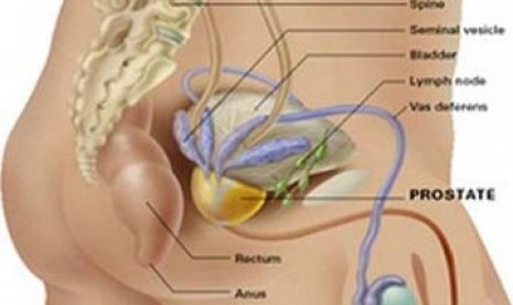 Kanker Prostat dapat disembuhkan dengan sejumlah metode pengobatan/ilustrasi