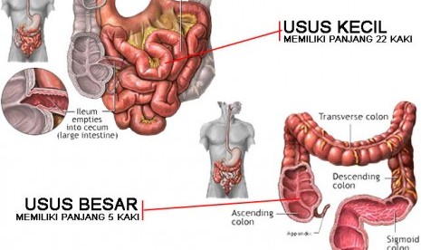 Kanker usus besar.