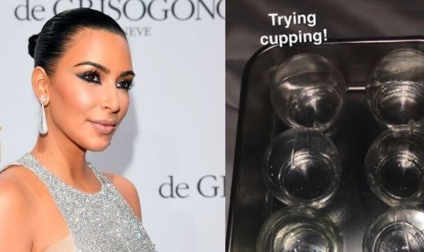 Kim Kardashian mencoba terapi bekam