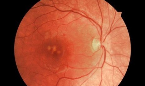 Luka yang disebabkan oleh pena laser penunjuk (laser pointer) pada retina remaja pria di Hobatt yang menyebabkan dia kehilangan 75 persen indera penglihatannya. 