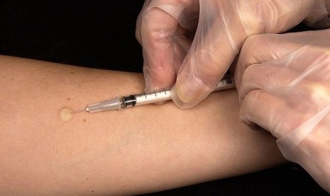 Mantoux tuberculin skin test is a test to detect TB infection. (illustration)