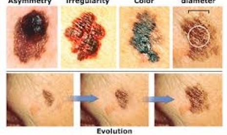 Melanoma