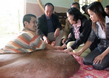 Nguyen Duy Hai mengidap tumor seberat 80 kilogram