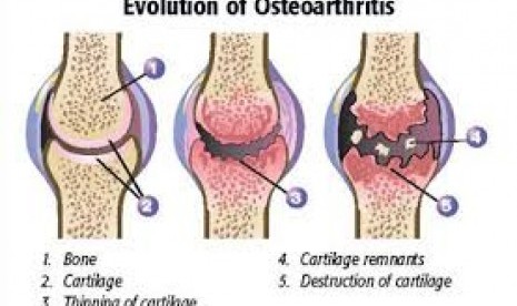 Osteoarthritis 