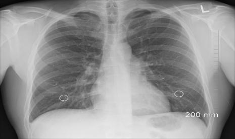 Data tunjukkan satu dari lim pasien tuberkulosis di dunia punya kebiasaan merokok.