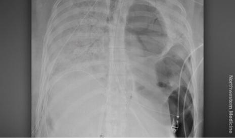 Paru pasien Covid-19 di Northwestern Medicine di Chicago, Amerika Serikat sebelum menjalani transplantasi.