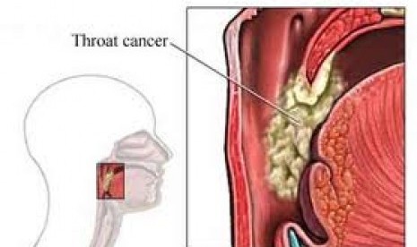 Penyakit kanker tenggorokan