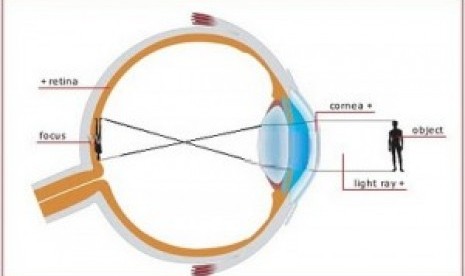 Penyakit rabun jauh atau miopi (ilustrasi).