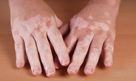 Penyakit vitiligo (ilustrasi)