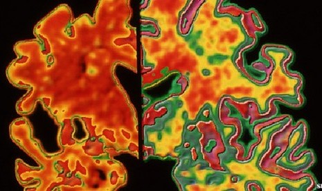 Perbandingan otak penderita Alzheimer (kiri) dengan otak normal (kanan)