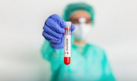 Health worker displays sample of monkeypox swab (Illustration).