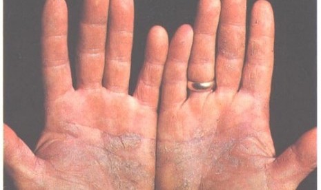 Psoriasis of palms (illustration)