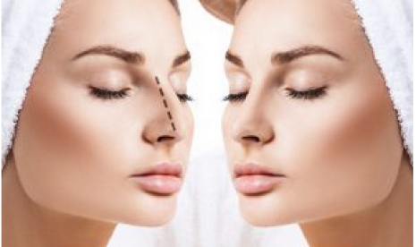 Rhinoplasty, operasi plastik di bagian hidung.