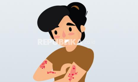 Ruam kulit (ilustrasi). Penderita flu tomat mengalami lecet atau lepuh merah seperti tomat yang secara bertahap bisa membesar hingga seukuran tomat.