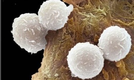 Sel darah putih pada pasien leukemia, hasil foto sains mikroskop elektronik. Leukemia dikenal juga dengan kanker sel darah putih.