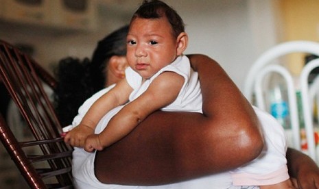 Seorang bayi yang terpapar virus zika