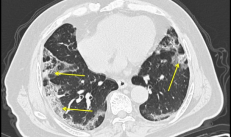  CT scan menunjukkan penyakit paru sedang dengan kekeruhan perifer di paru-paru (panah). Orang bisa saja negatif Covid-19 meskipun hasil CT scan menunjukkan adanya indikasi. Mereka juga mungkin mengalami gejala Covid-19.