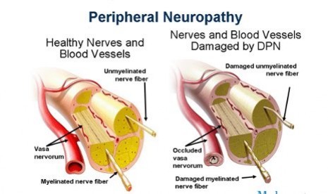 Skema kerusakan saraf tepi atau neuropati