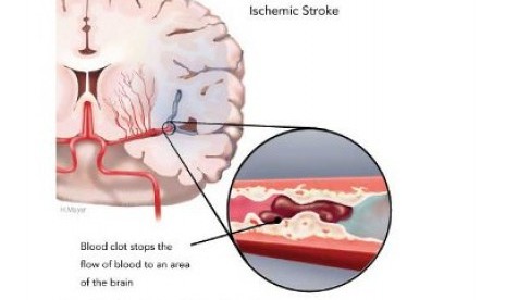 Skema stroke (ilustrasi)