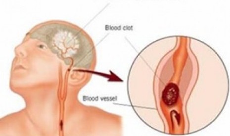 Ini Tiga Testimoni Penderita Stroke Republika Online