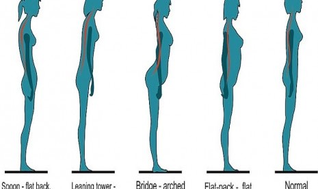 Struktur punggung berpengaruh kepada kemungkinan sakit punggung di masa mendatang