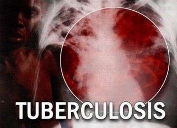 Tuberkulosis