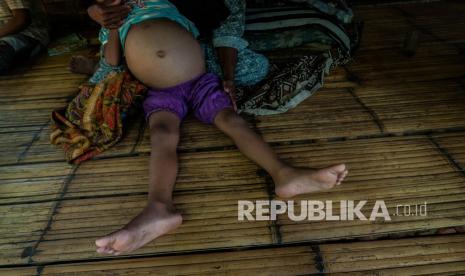 Uniyah (8) penderita gizi buruk ditemani ibunya Zubaedah (45) duduk di depan rumahnya di Desa Muncang Kopong, Lebak, Banten, Kamis (12/8/2021). Uniyah (8) penderita anak asal Kabupaten Lebak tersebut mengalami gizi buruk sejak berusia empat tahun dan saat ini mengharapkan perhatian dari pemerintah setempat. 