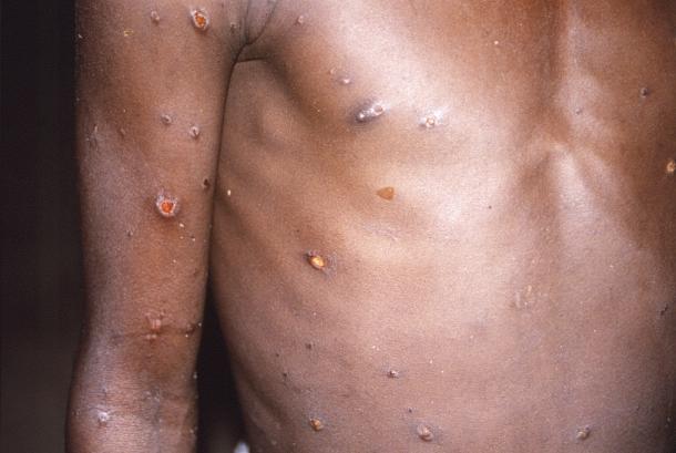 Foto yang dipasok CDC pada 1997 memperlihatkan kulit lengan kanan dan dada seorang pasien ditumbuhi lesi cacar monyet. Selama lesi masih ada, pasien cacar monyet masih bisa menularkan penyakitnya.