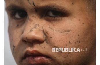 Bocah Palestina Kehilangan Penglihatan Akibat Serangan Israel di Gaza