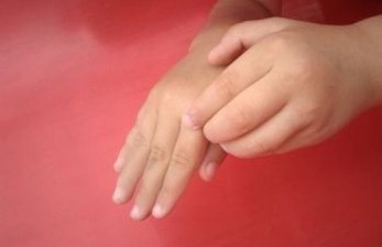 Faktor Ras dan Keturunan Jadi Risiko Utama Anak Kena Alergi