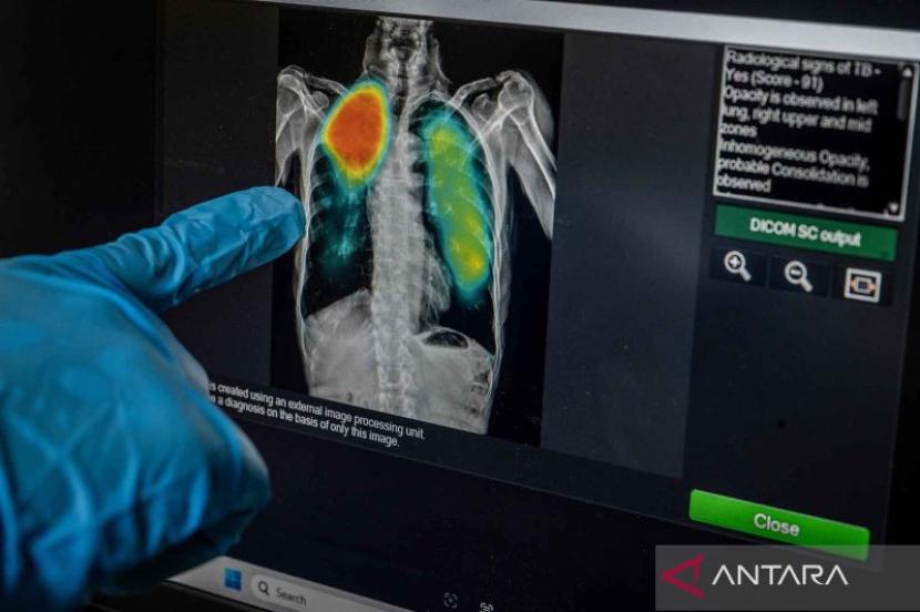 Rendahnya Literasi dan Stigma Hambat Pengobatan TBC